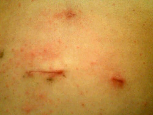 23-days-post-op-with-itchy-red-bumps-on-stomach-post-operation-lap